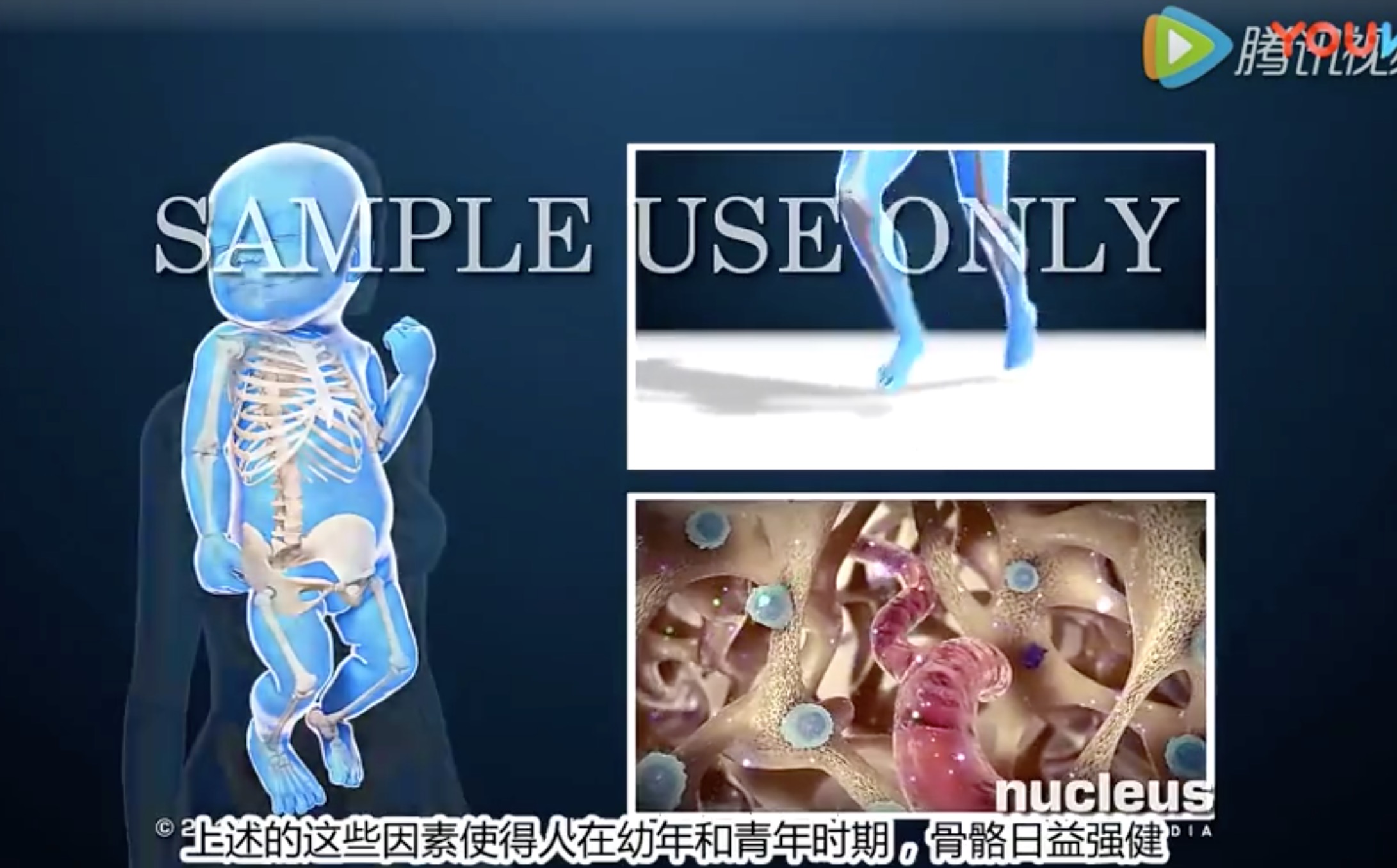 3D动画骨质疏松症中文字幕版