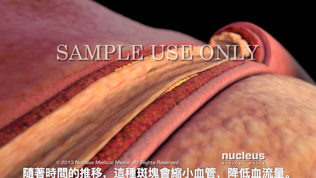 3D动画透视胆固醇在人体的奥秘