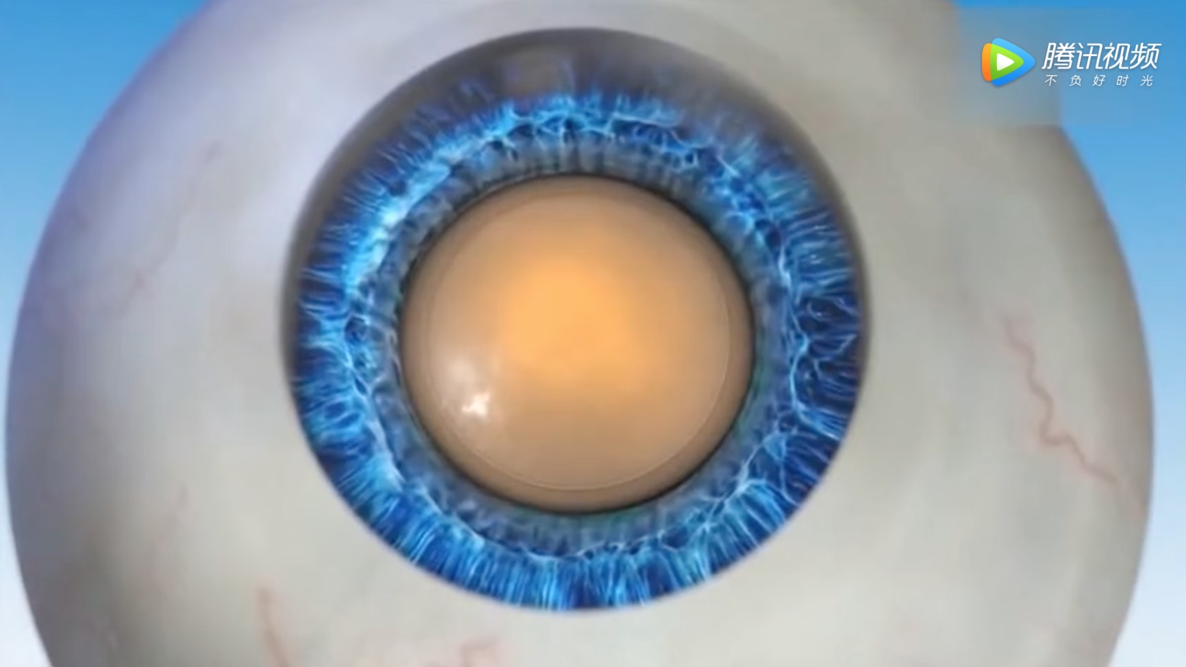3D动画显示白内障手术,惊人的现代医疗技术