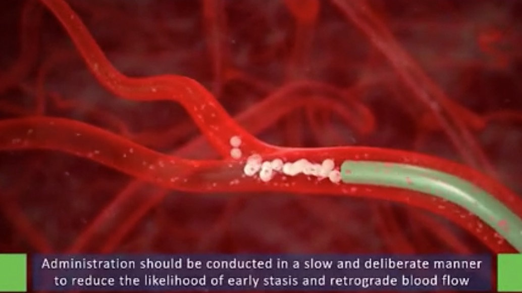 化疗治疗肝癌- SIR Spheres Chemoembolization Treatment