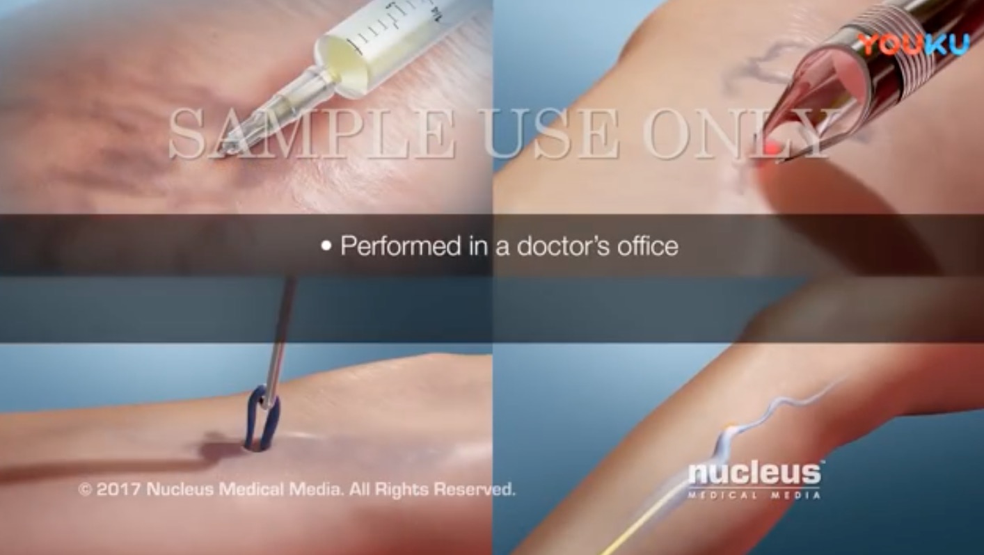 静脉曲张治疗科普 1 Treatment for Varicose Veins Nucleus Health