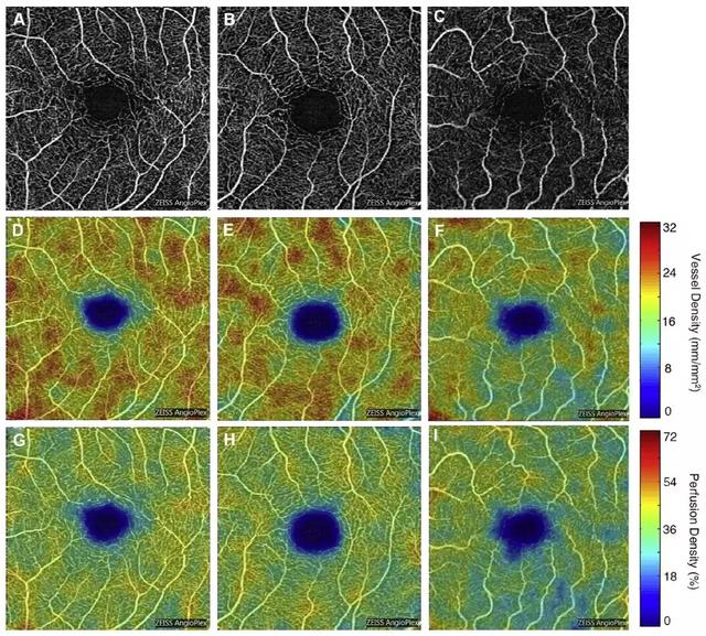 杜克大学最新研究:视网膜血管变化,透露阿尔茨海默症征兆?-肽度TIMEDOO