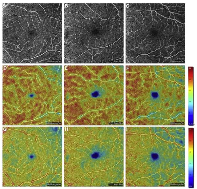 杜克大学最新研究:视网膜血管变化,透露阿尔茨海默症征兆?-肽度TIMEDOO