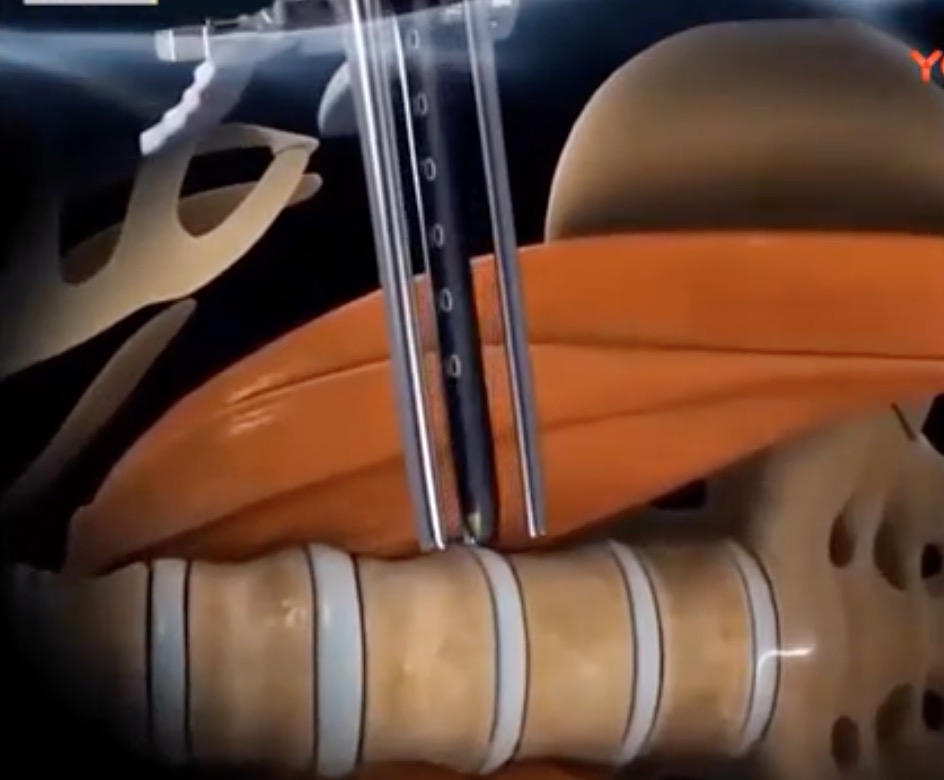 【3D动画】看看国外的高端医疗新技术