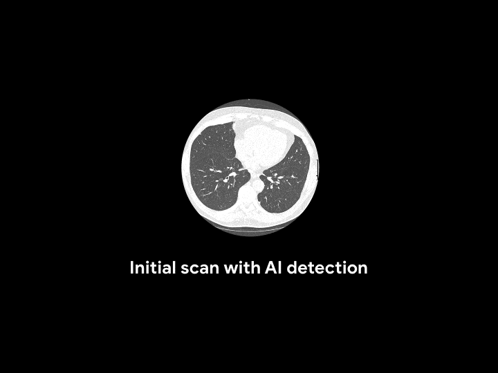 肺癌预测的人机对决：谷歌 AI 挫败 6 位放射专家-肽度TIMEDOO