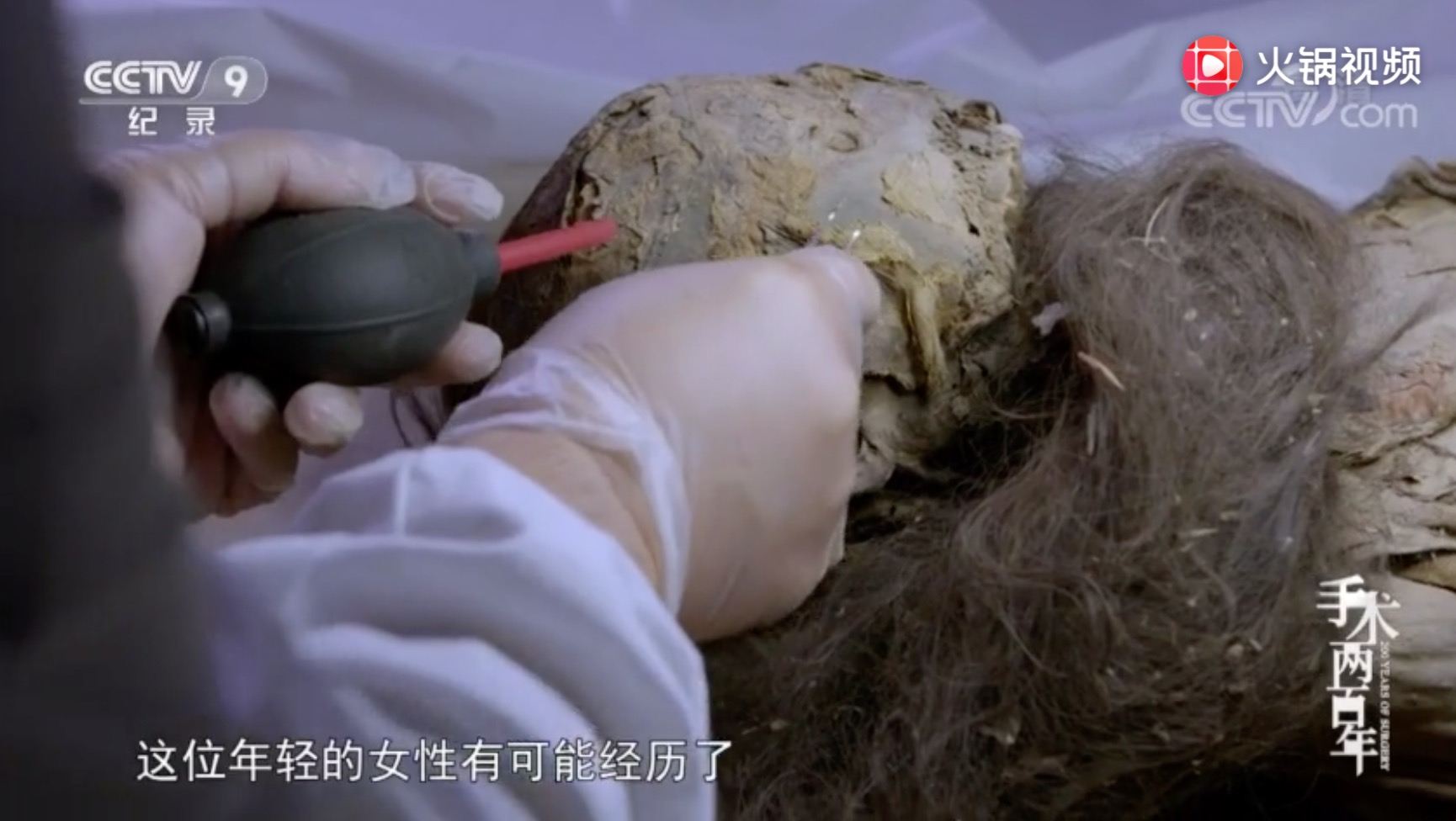 手术两百年|1500年前疑似剖宫产手术