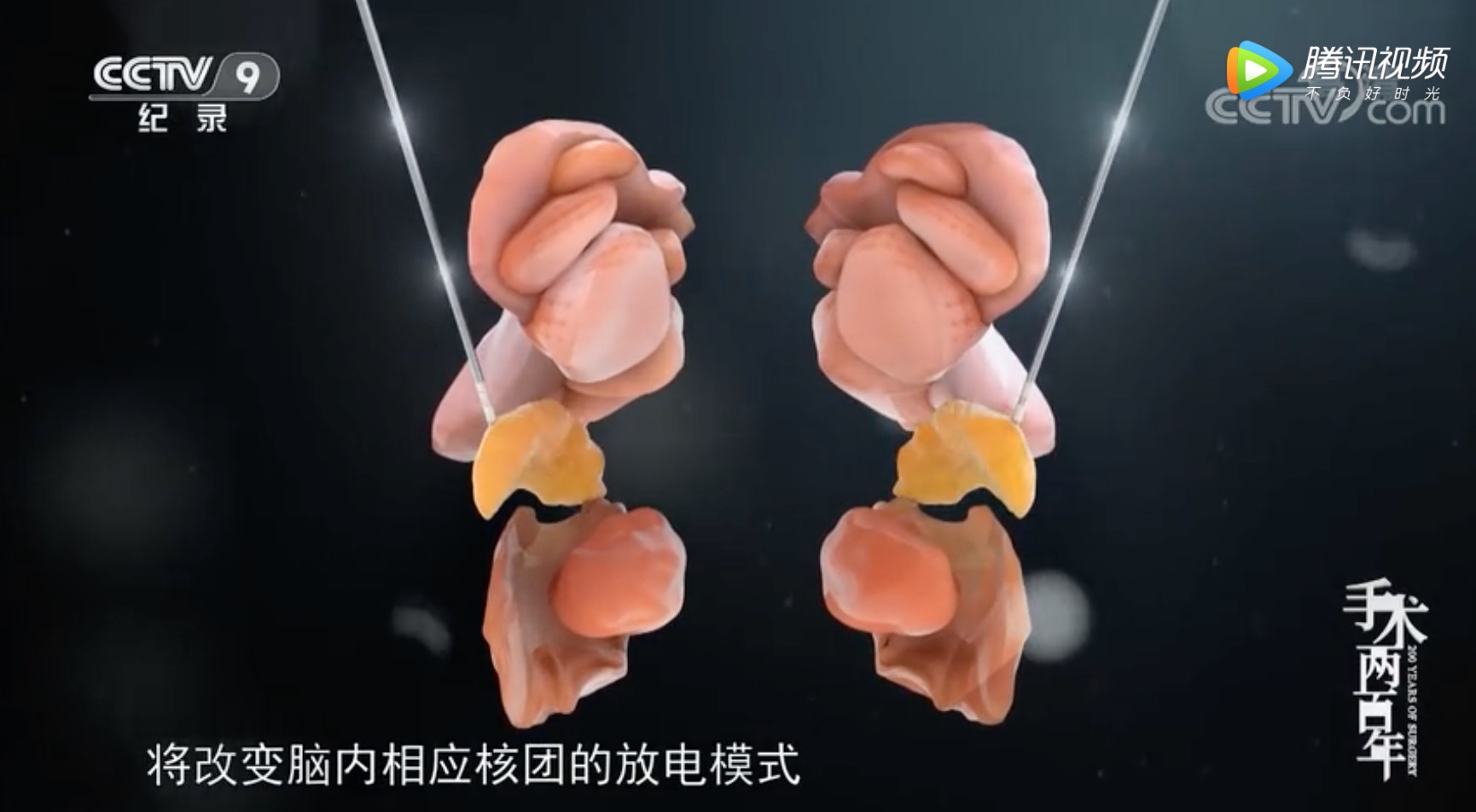 《手术两百年》之脑深部电刺激术