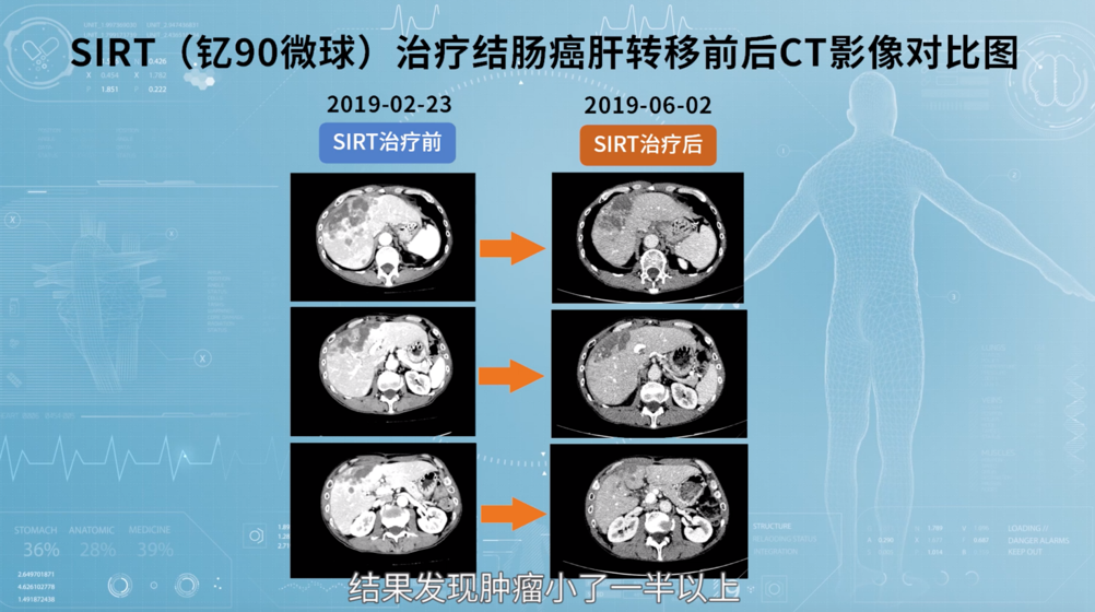 对付凶险晚期肝癌,这个医生集团有新手段-肽度TIMEDOO