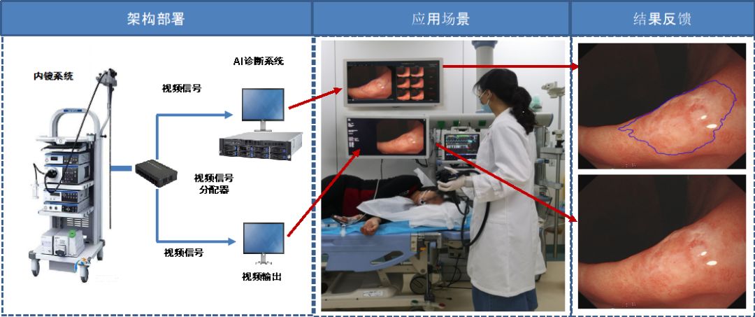 肿瘤早诊的“火眼金睛”——徐瑞华教授团队成功研发上消化道肿瘤内镜AI辅助诊断系统-肽度TIMEDOO
