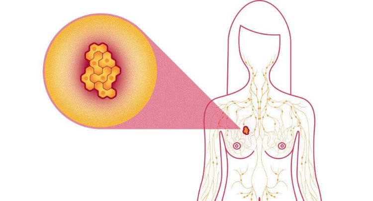 纽约大学医学院: AI成放射医生得力助手 乳癌识别准确度达9成