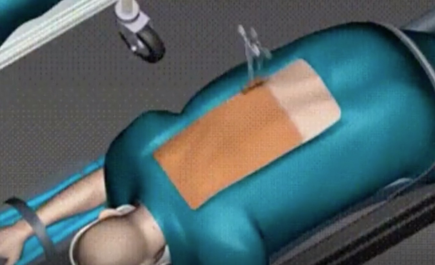 3D医学动画|演示脊柱侧弯纠正手术-肽度TIMEDOO