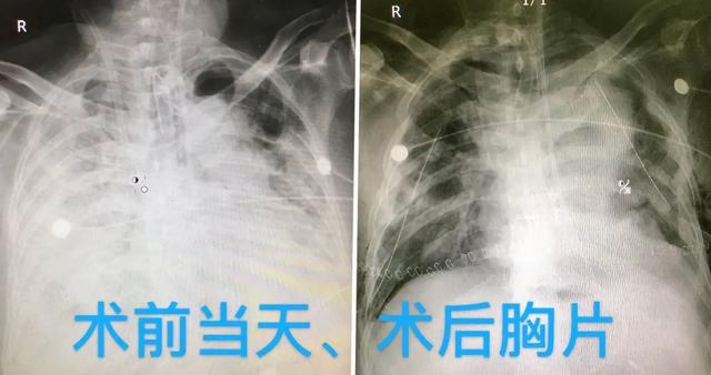 全球首例！59岁新冠肺炎患者成功接受肺移植手术-肽度TIMEDOO