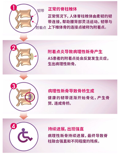 可善挺®新适应症获批,诺华进军风湿治疗领域-肽度TIMEDOO