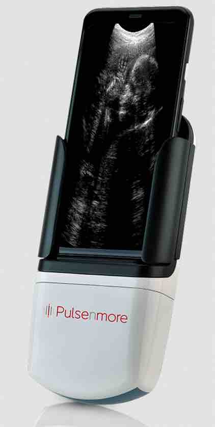 以色列PulseNmore:开发用于孕妇的家用远程超声检查设备-肽度TIMEDOO