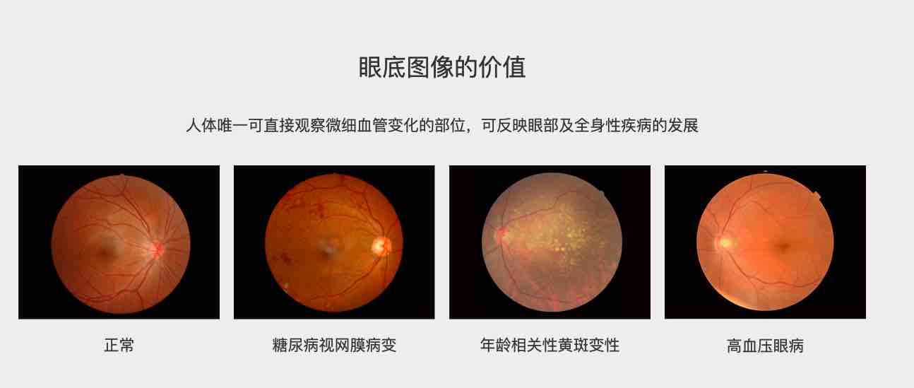深圳硅基智能:成功获中国首批糖网筛查AI辅助诊断软件三类证-肽度TIMEDOO