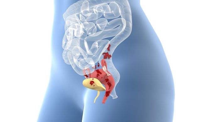 单细胞分辨率揭示人薄型子宫内膜发病机制