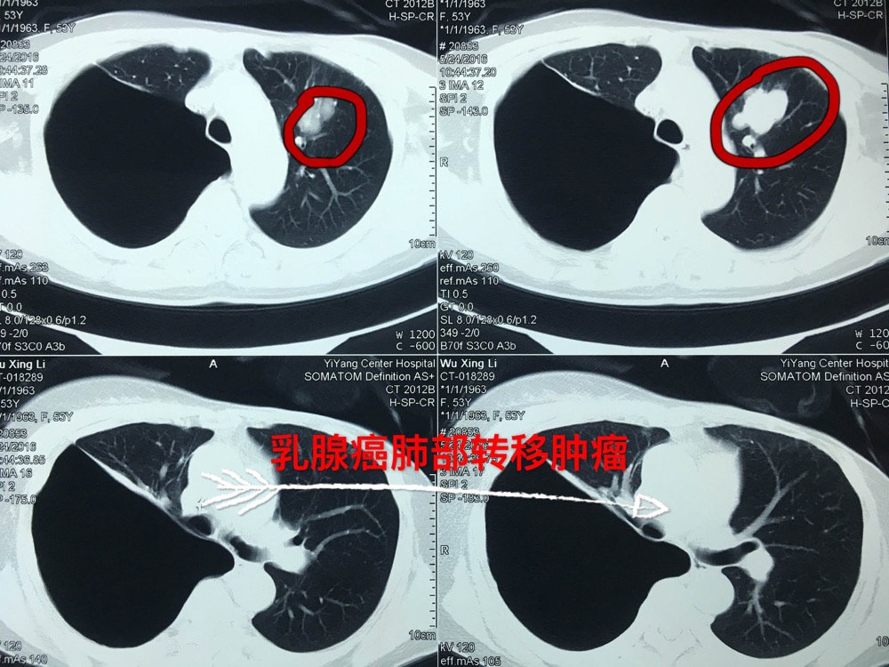 乳腺癌脑转移患者或有“中国方案”