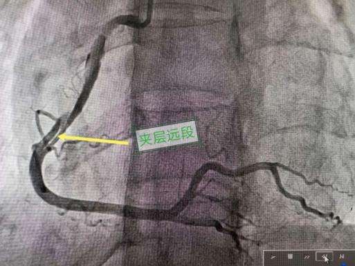 新研究发现一种引发女性为主的心脏病的基因基础