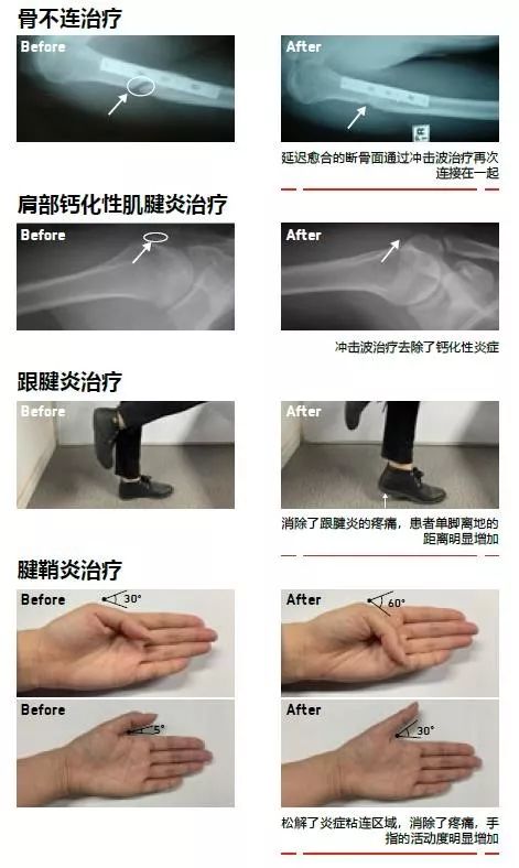 揭秘“不流血的手术刀”的前世今生|SPT疼痛管理5月14日直播-肽度TIMEDOO