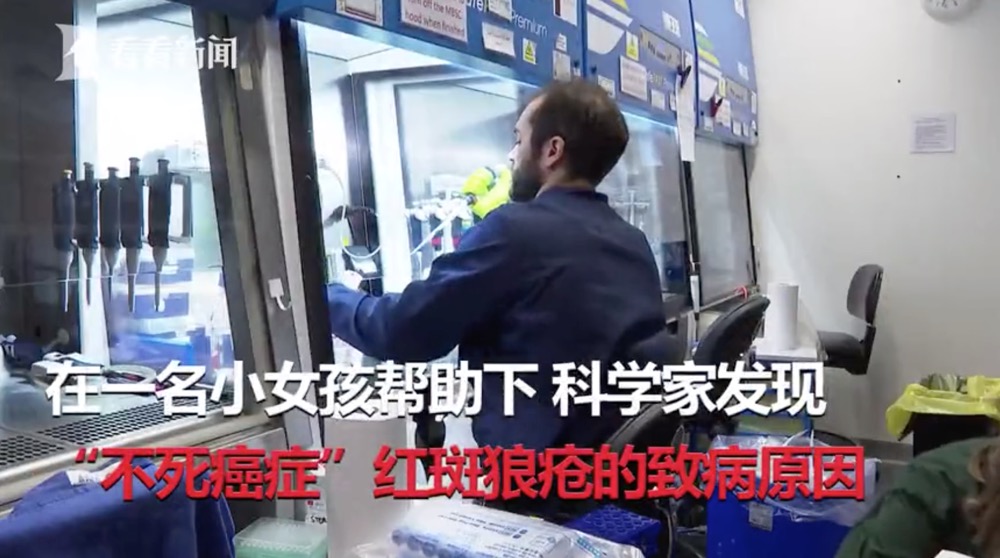 红斑狼疮致病基因新发现有助寻找新疗法