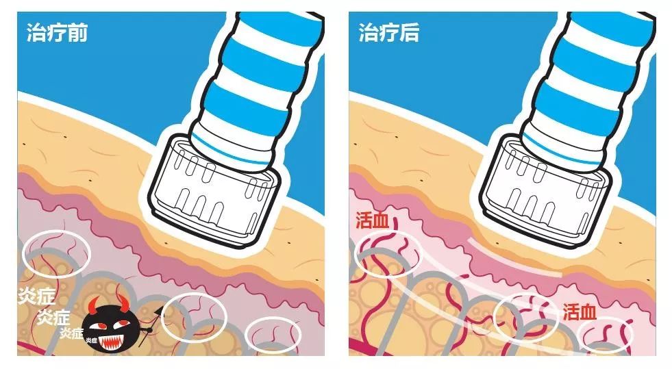 揭秘“不流血的手术刀”的前世今生|SPT疼痛管理7月9日直播-肽度TIMEDOO