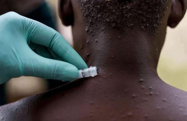 英国猴痘患者研究：症状与此前患者不同，通过皮肤接触和性传播
