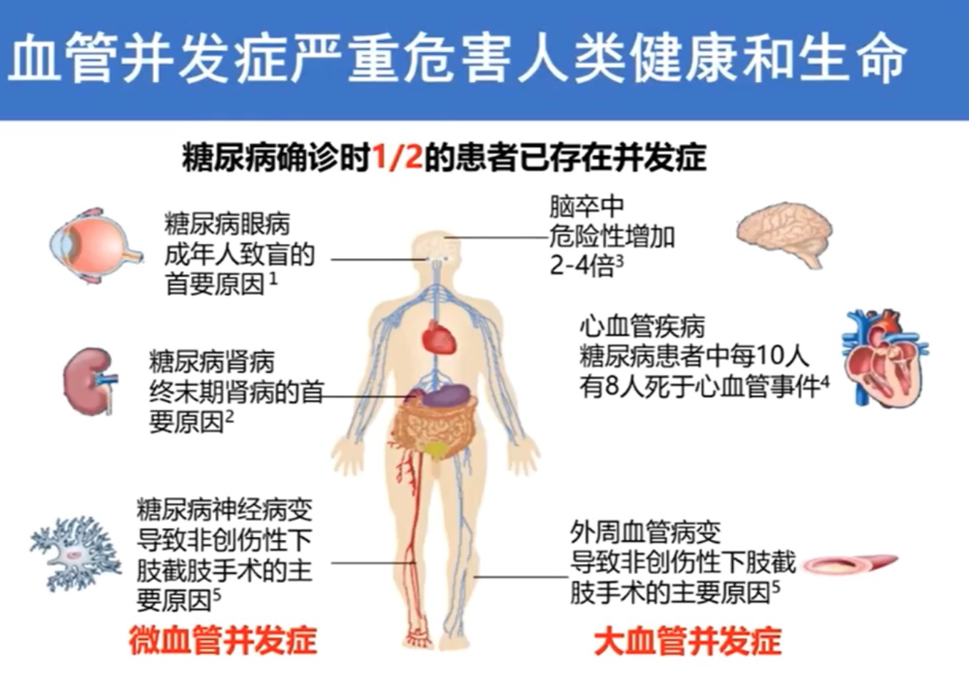 专家权威解读｜糖尿病并发症——隐藏在糖尿病背后的“杀手”