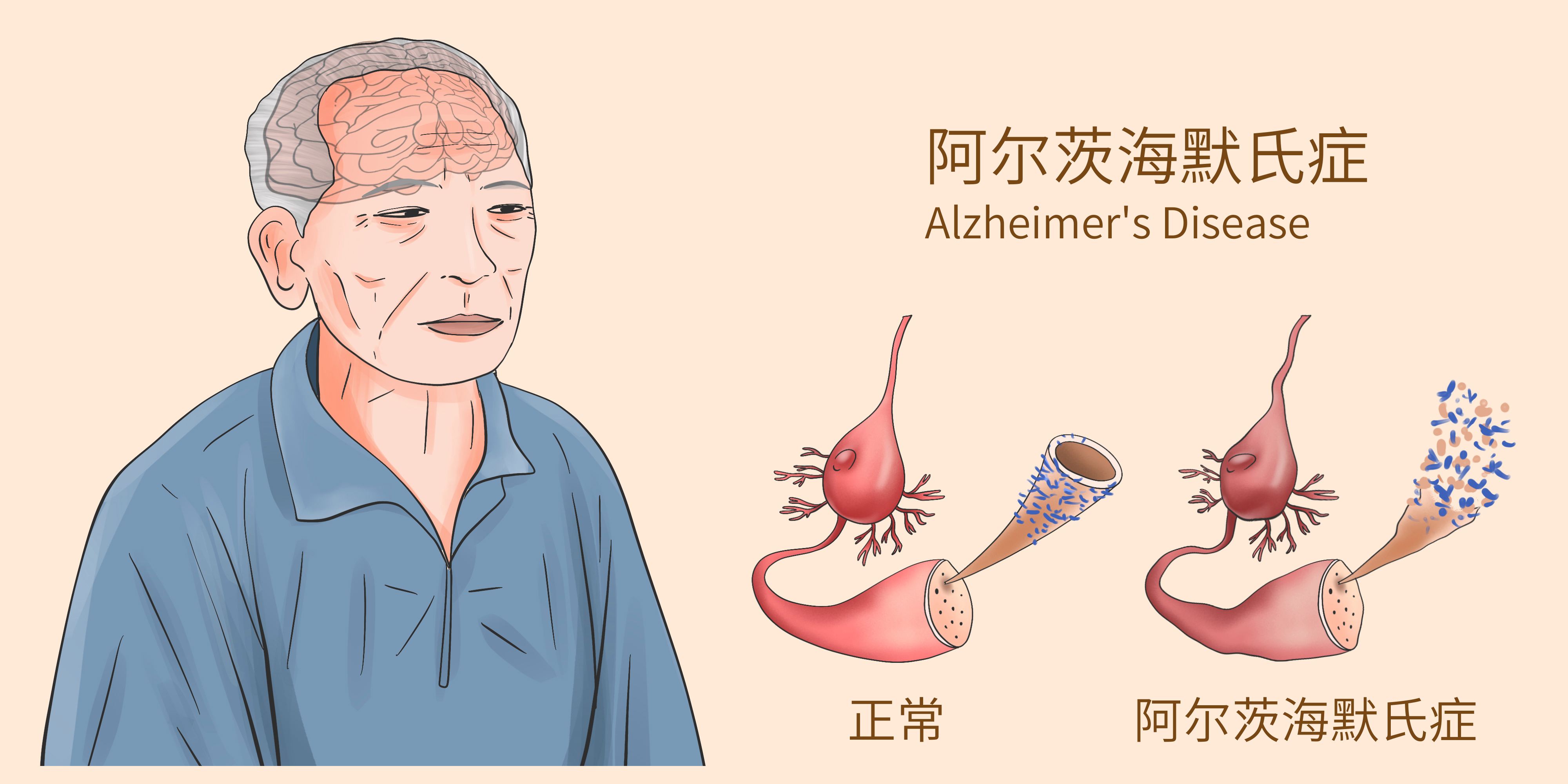 港科大发现血液蛋白新靶点 为治疗阿尔茨海默病提供新方向