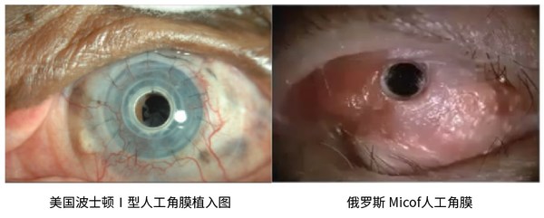 国产领扣型人工角膜手术在各重点医院开展，为角膜盲患者带来希望-肽度TIMEDOO