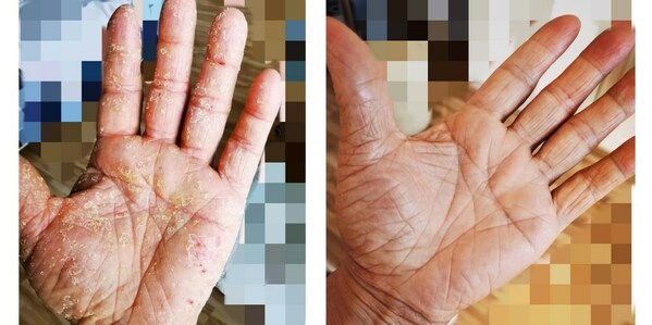 图3 以AD患者为受试者进行药物临床试验,经三生国健IL-4Rα单抗治疗两次后结果如图(左:用药前;右:用药后) 三生国健--明星靶点IL-4Rα:过敏性疾病关键角色-肽度TIMEDOO