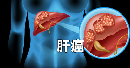 肝癌潜在新疗法出现