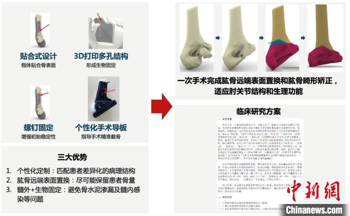 中国自主研发新型表面置换假体 填补空白、造福肘关节损伤者