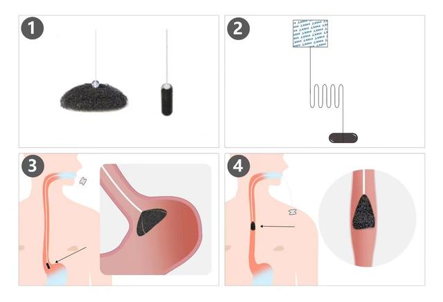 吞服一粒胶囊实现食管癌筛查？长海医院发布一项研究突破