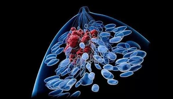 晚期乳腺癌一线治疗有了可替代选择