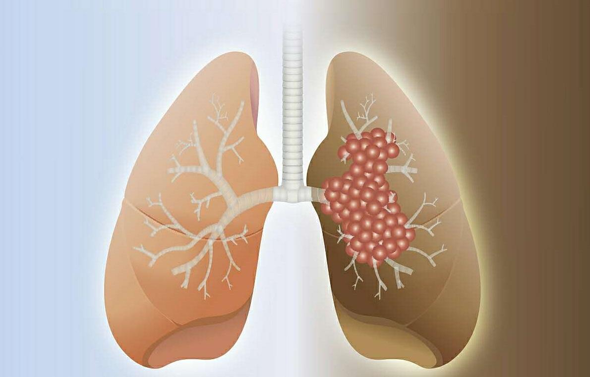 ADAURA III期临床研究显示，泰瑞沙治疗早期EGFR突变肺癌取得前所未有的生存获益，患者5年生存率达88%