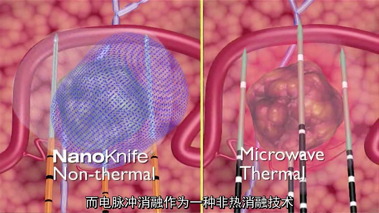 FARAPULSE脉冲电场消融系统ADVENT研究至主要有效性和安全性终点