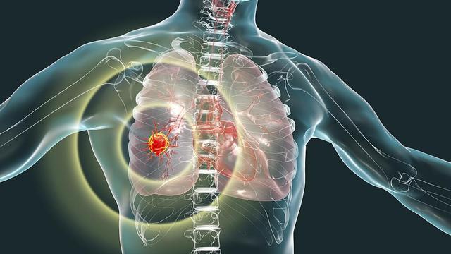上海交大医学院专家团队最新研究：首次阐明真菌促进肺癌发展的分子机制