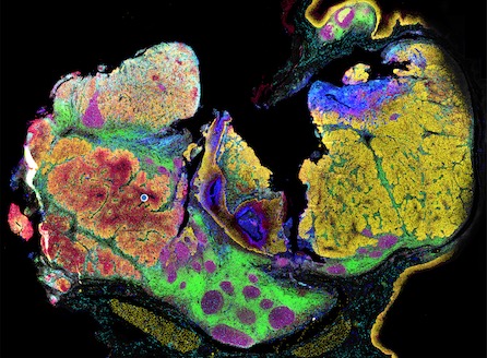 新一代单细胞空间蛋白分析：解析头颈癌肿瘤的生物标志物与治疗策略
