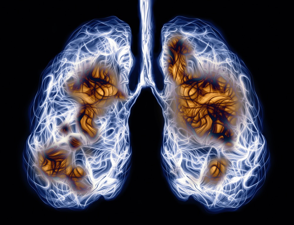 模拟肺部生物膜新平台：诺丁汉大学科学家突破囊性纤维化感染研究