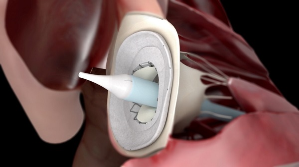 ReValve Solutions宣布其新一代经导管二尖瓣置换术(TMVR)技术首次成功应用于人体
