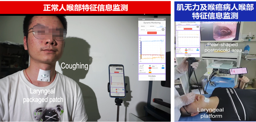 不做喉镜也能监测喉部康复-肽度TIMEDOO