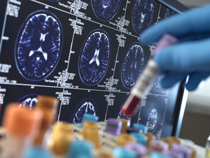 马萨诸塞大学阿默斯特分校研究团队获NIH拨款，利用深度学习开发阿尔茨海默病早期预测模型