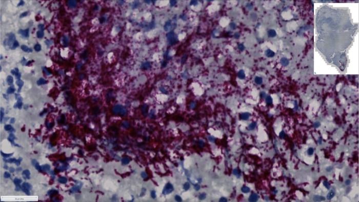 揭示结直肠癌潜在元凶：特定亚型Fusobacterium nucleatum引发肿瘤生长