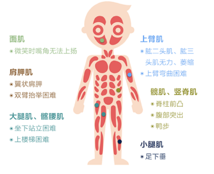 面肩肱型肌营养不良症——折翼的小飞侠