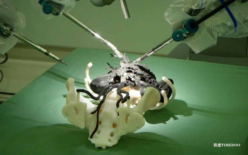 3D打印的生物活性材料有望修复大范围肌腱撕裂