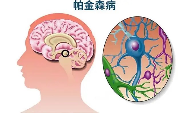 自闭症患者和智力障碍人士患帕金森病风险远高普通人