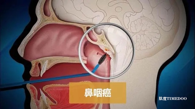 港中大医学院研发mRNA药物 可治疗鼻咽癌