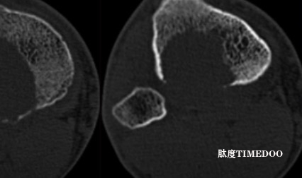 湘雅二医院在骨肿瘤及纳米材料领域获新成果