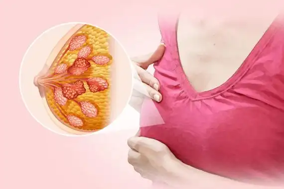 新研究为转移性乳腺癌患者治疗带来新选择
