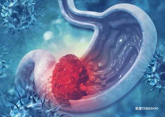 新研究可有效预测胃癌腹膜转移的标志物